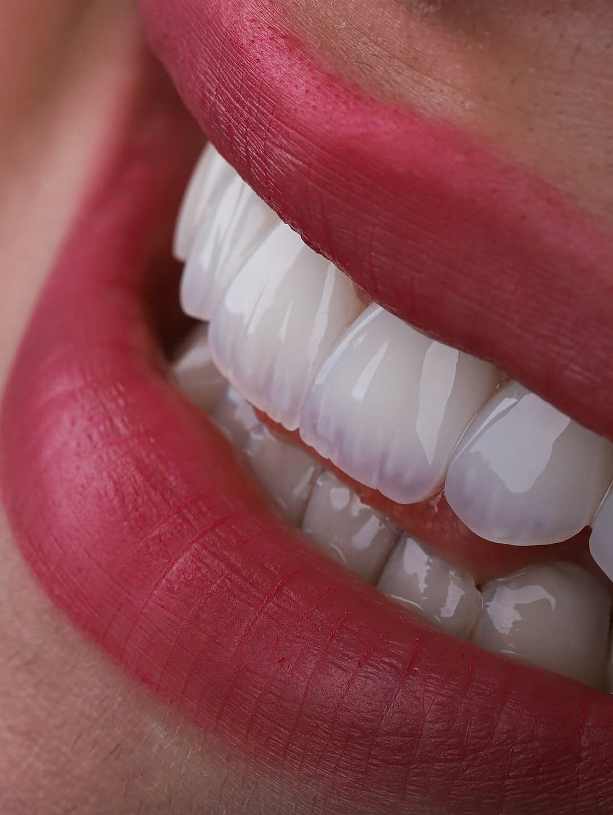 Smile Makeover