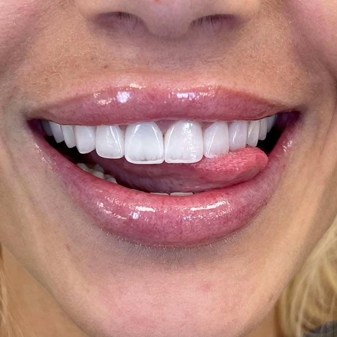 Veneers